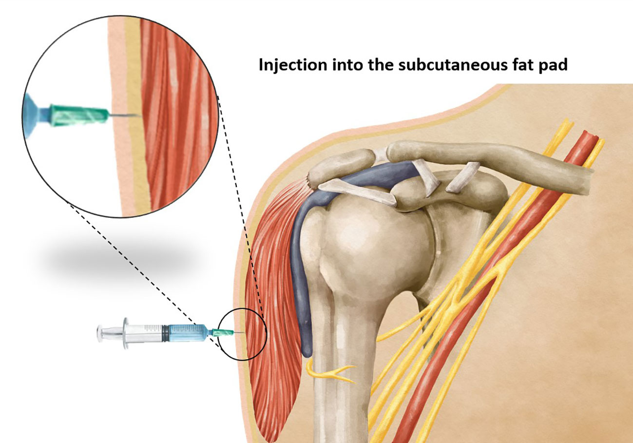 Shoulder Injury-Related Vaccine Administration- Sports Medicine Review