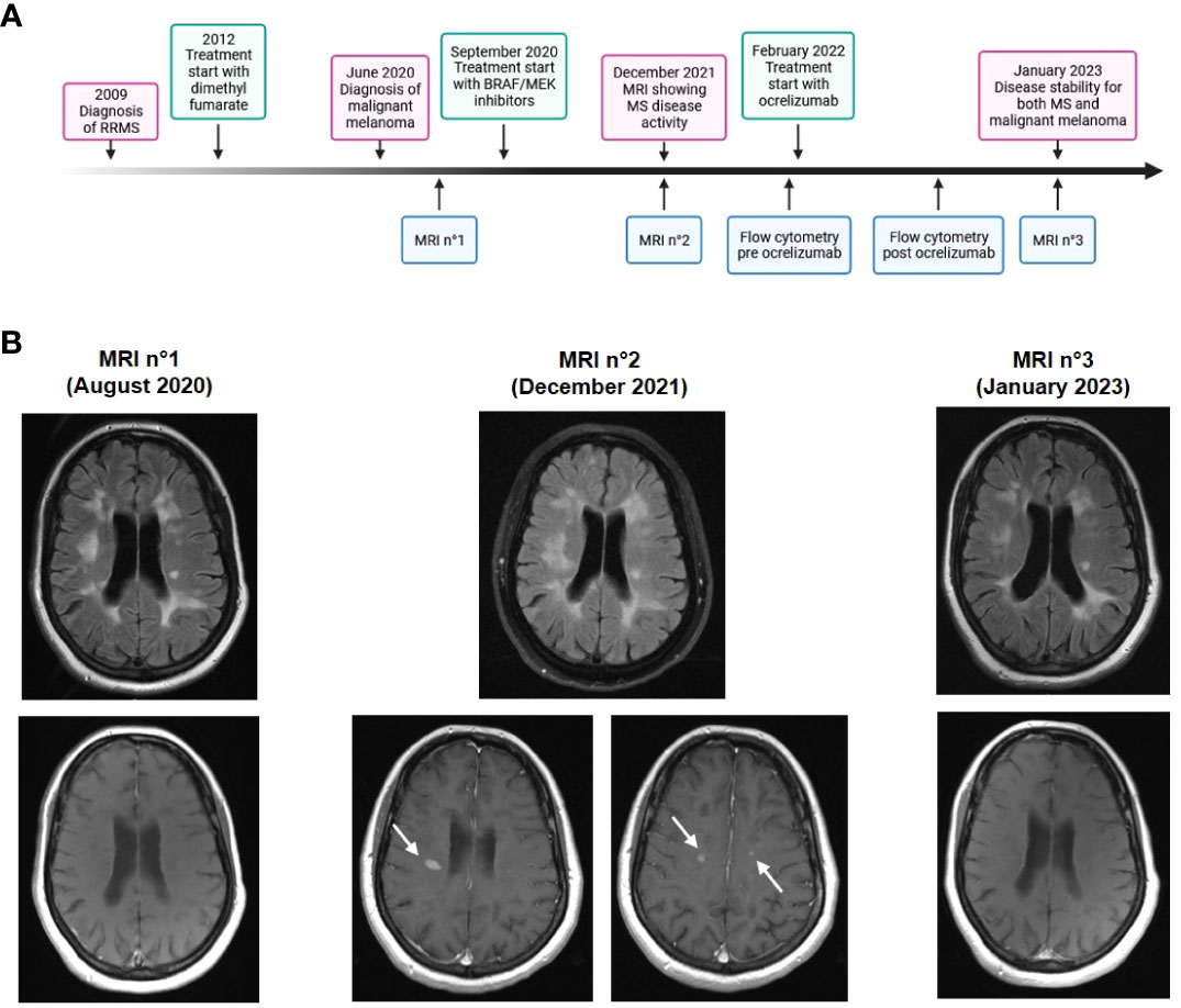 Frontiers | Case Report: Balancing immune responses – multiple ...