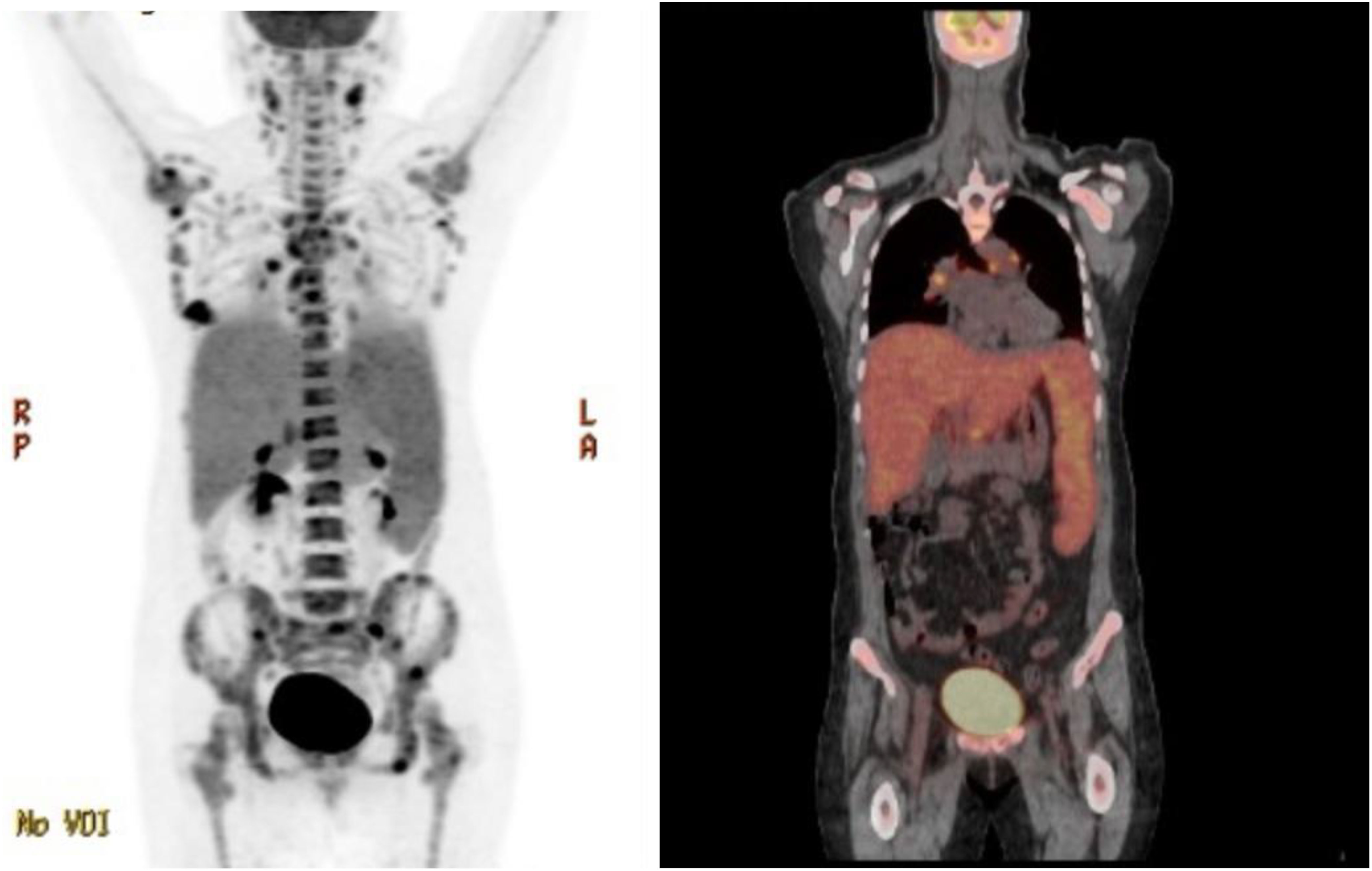 Frontiers | Case report: An exceptional responder of low-dose ...