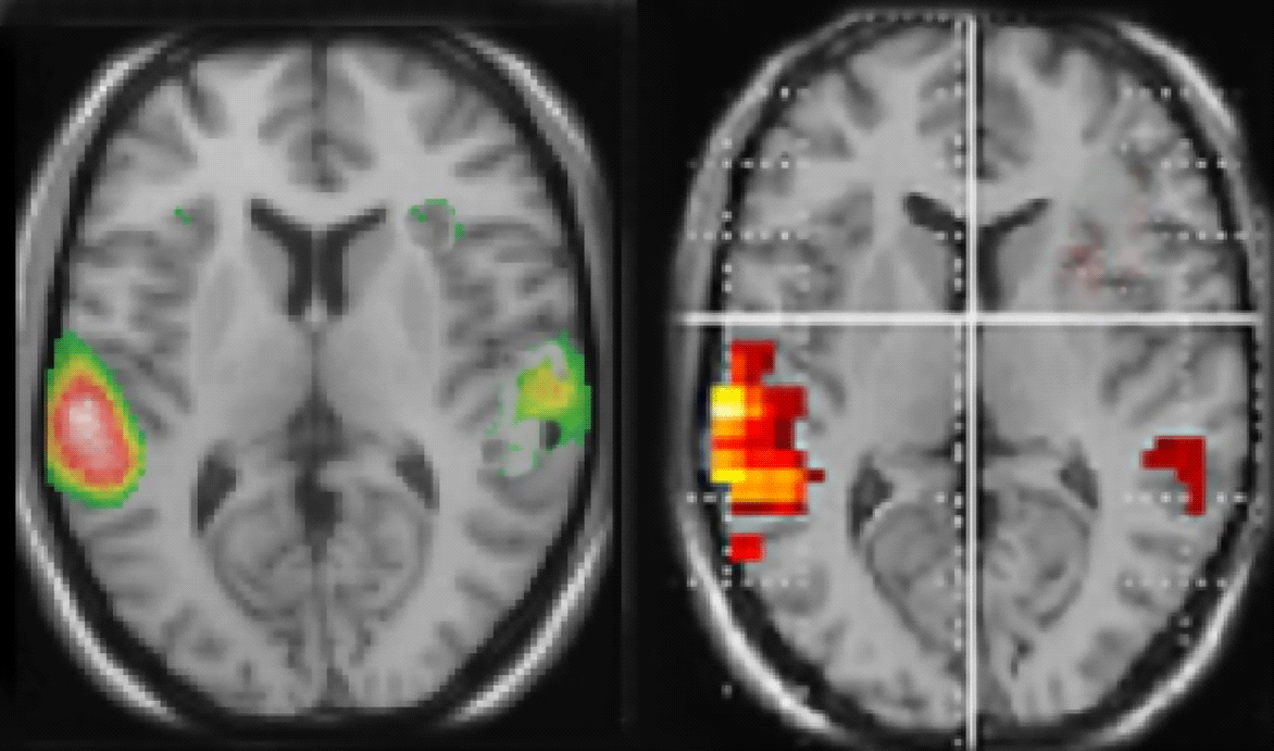 schizophrenia auditory hallucinations