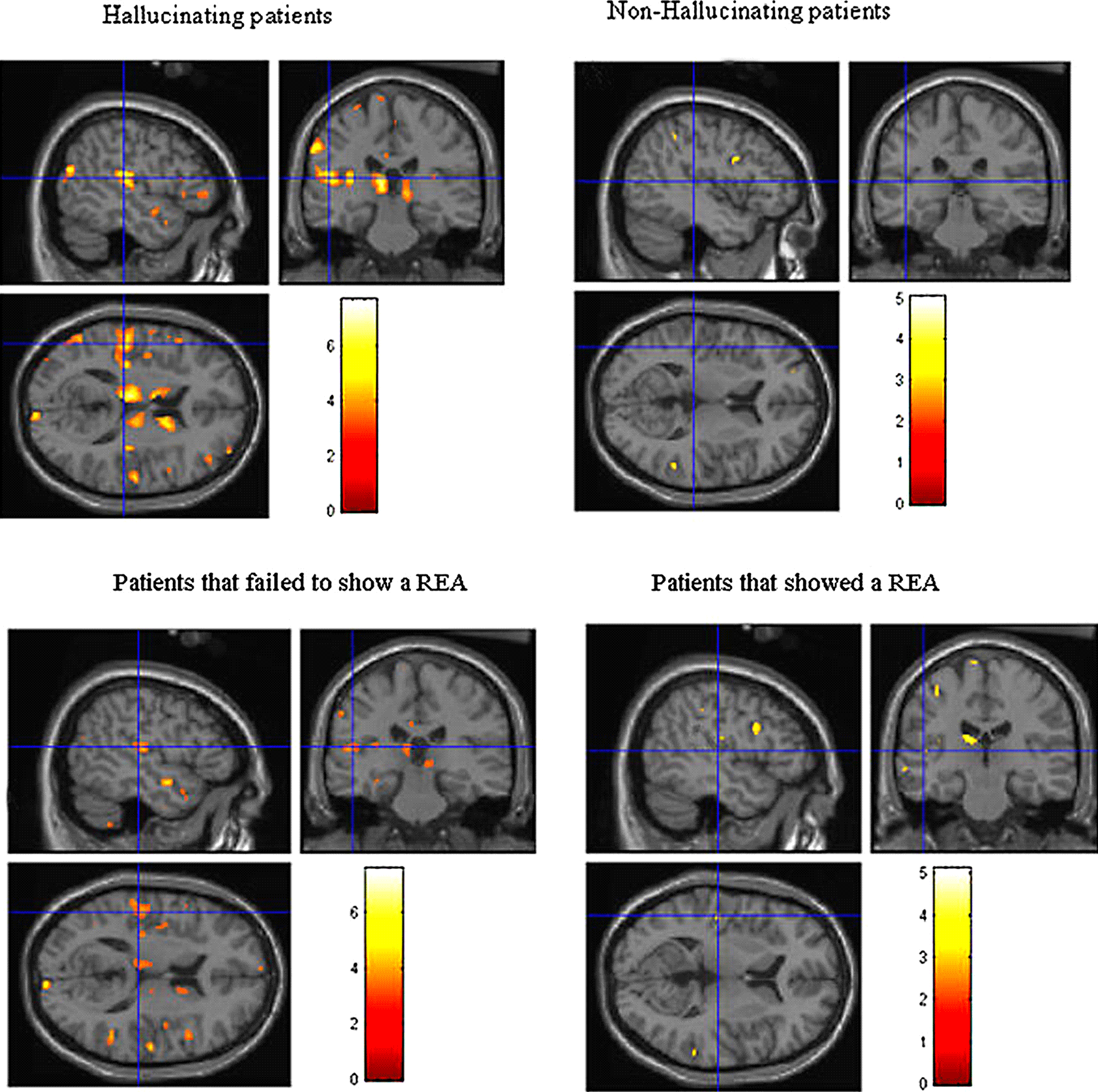 schizophrenia auditory hallucinations