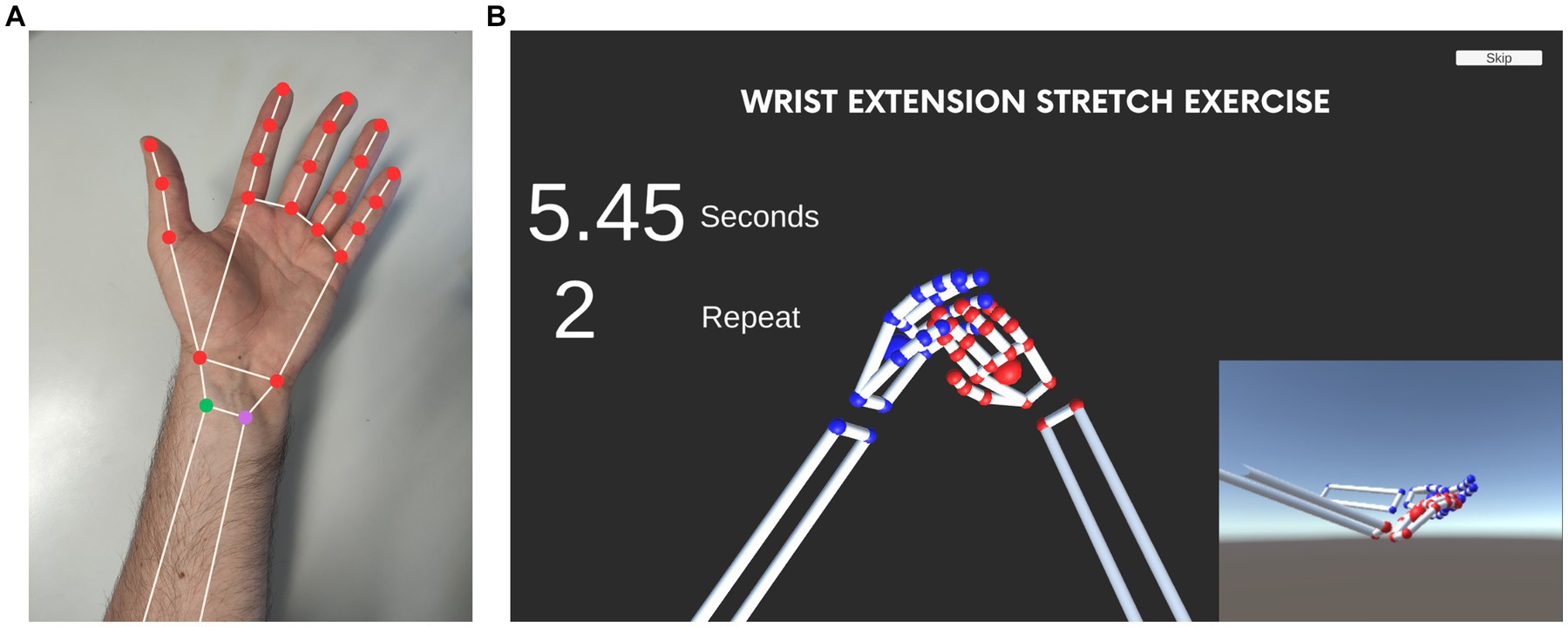 Carpal Tunnel Syndrome Therapeutic Exercise Program - OrthoInfo - AAOS