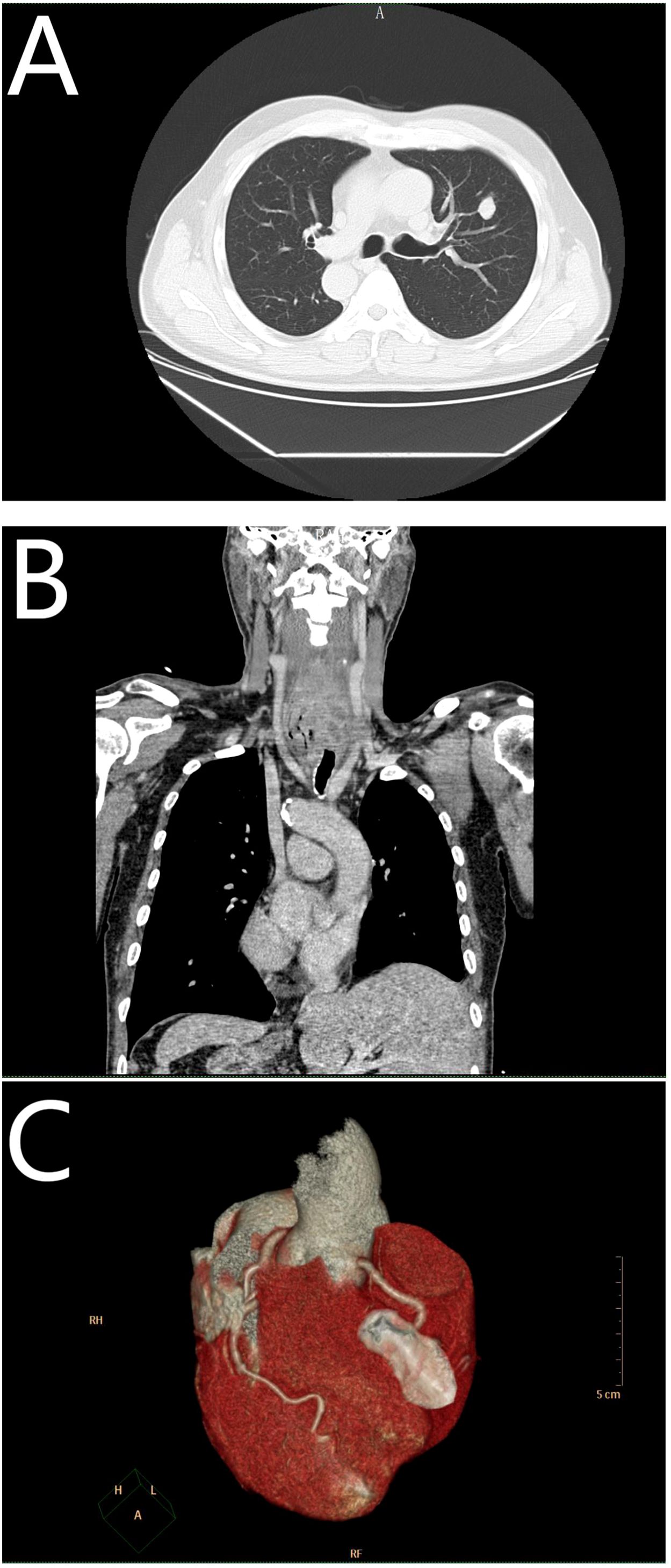 Panel A shows a transverse CT scan of the chest highlighting the lungs and thoracic organs. Panel B is a coronal CT scan displaying the thoracic structures, including the spine and major blood vessels. Panel C presents a 3D reconstructed image of the heart, emphasizing the surface anatomy and major vessels.