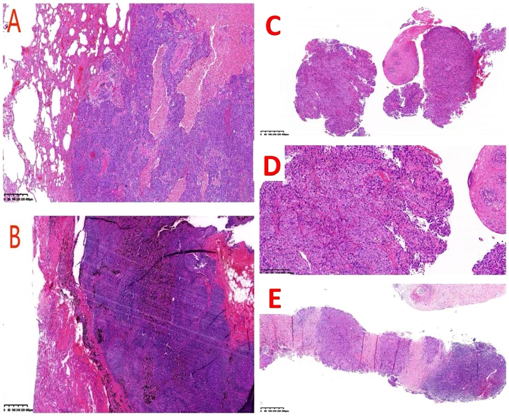 Histological images labeled A to E show stained tissue samples under a microscope. Each sample exhibits varying patterns and densities, with distinct pink and purple hues indicating cellular structures and abnormalities. The differences in texture and composition across these samples suggest various tissue types or conditions.