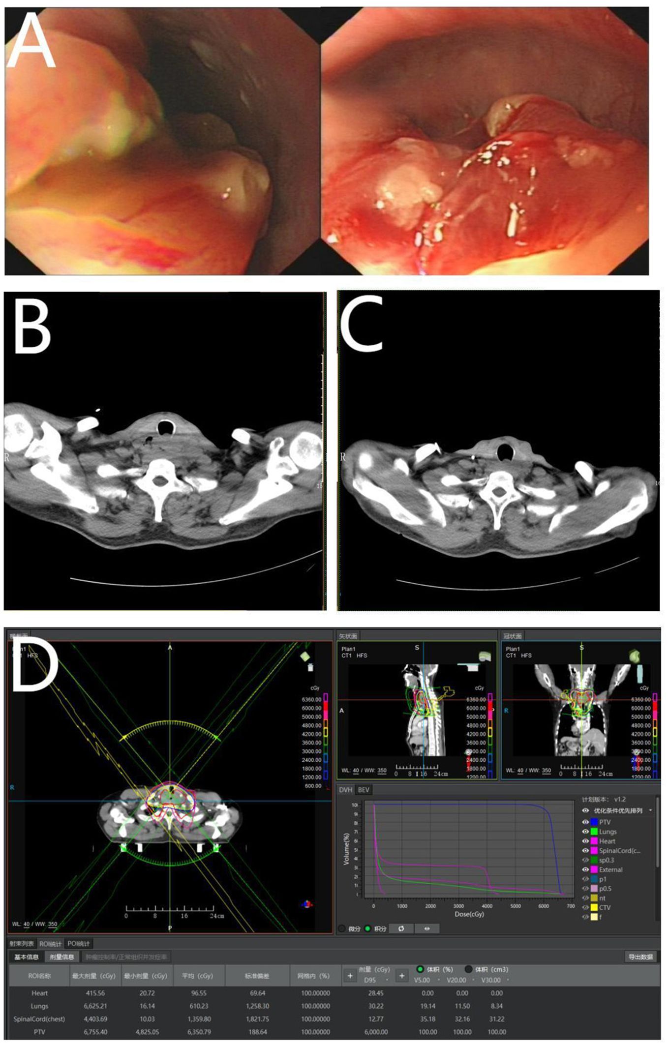 Image A shows two endoscopic views of a mass in the esophagus, with varying degrees of redness and ulceration. Images B and C are axial CT scans showing a cross-sectional view at the level of the neck, highlighting anatomical structures. Image D is a radiotherapy planning screen displaying a 3D model with colored dose distribution lines, a dose-volume histogram, and treatment parameters for targeted radiation delivery.