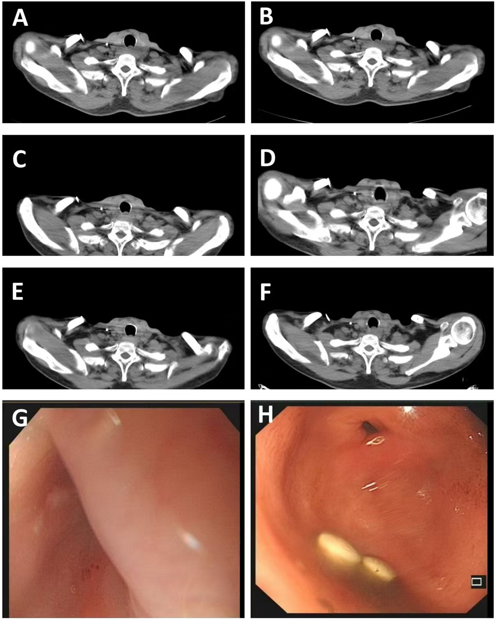 CT scan images labeled A to F show cross-sectional views of the neck area with varying densities and structures. Images G and H are endoscopic views, depicting the interior of a body cavity with visible reddish tissue and some reflective surfaces.