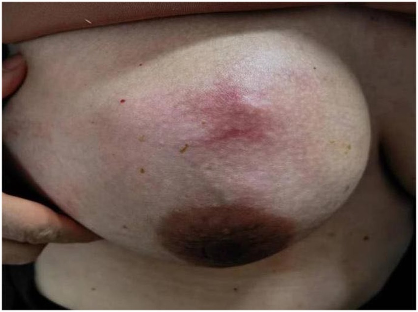 PDF) Necrotizing Cutaneous Fungal Infection of the Breast in a