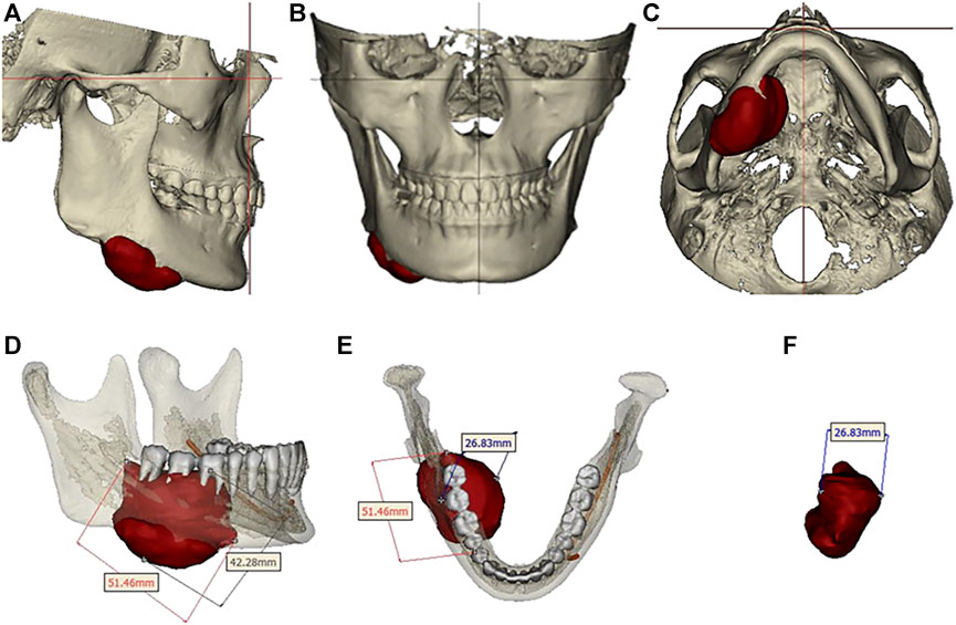 Mandibular reconstruction using a 3D-printed titanium implant with internal  scaffold