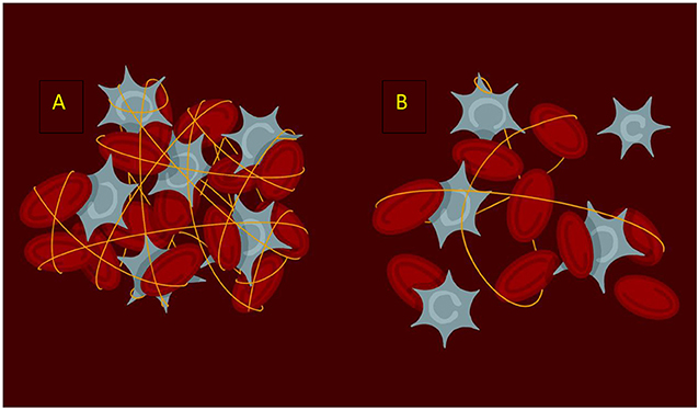Figure 1 - (A) A normal blood clot in which the platelets (gray) are knitted together by fibrin (yellow strands) to make a strong clot that stays in place.