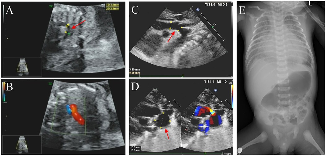 Ultrasound and X-ray images of the proband. Images A, B, C, and D show the echocardiography of the proband. In images A and C, the red arrowhead points out the coarctation of the aortic arch during the fetal period and the neonatal period, respectively. Image B shows pulmonary and aortic blood flow incongruity with an increased vessel ratio. Image D shows a patent ductus arteriosus aneurysm (marked with an arrowhead) and a bidirectional arterial shunt. Image E is an X-ray of the proband's torso, showing the ribcage and spine with no obvious abnormalities.
