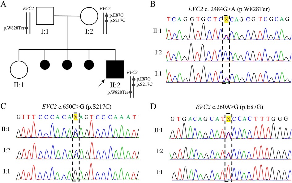 Genetic analysis image showing a pedigree chart (Panel A) and DNA sequencing chromatograms for EVC2 mutations (Panels B-D). Panel A displays a familial inheritance pattern with indicated mutations. Panel B illustrates the EVC2 c.2484G>A (p.W828Ter) mutation chromatograms for three individuals. Panel C reveals the EVC2 c.650C>G (p.S217C) mutation chromatograms. Panel D shows the EVC2 c.260A>G (p.E87G) mutation chromatograms. Each chromatogram highlights the specific nucleotide changes.