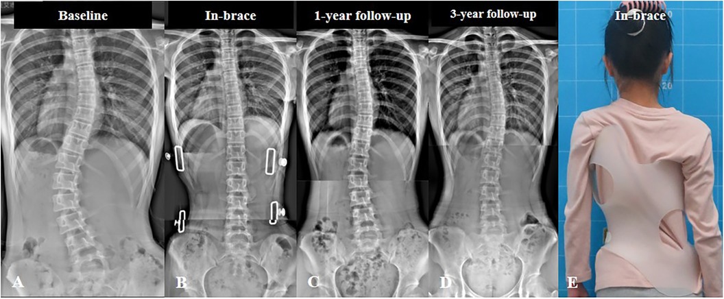 Adolescent Idiopathic Scoliosis: Advances and new Perspectives | Frontiers  Research Topic