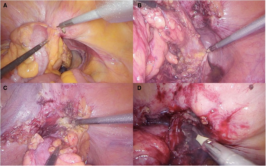 A and B) Diverticulum tracted to approach de neck dissection C