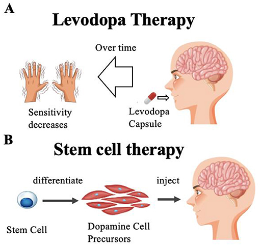 Diagram comparing two therapies for brain disorders. A) Levodopa Therapy: Shows reduced sensitivity in hands over time with a person taking a levodopa capsule. B) Stem Cell Therapy: Illustrates stem cells differentiating into dopamine cell precursors before being injected into the brain.