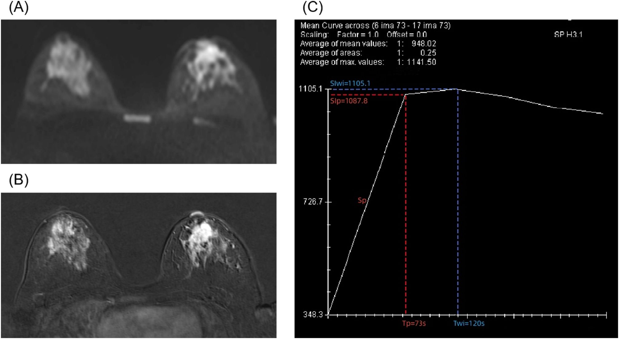 (A) MRI scan showing a cross-sectional view of two areas with high signal intensity. (B) Enhanced MRI scan highlighting the same areas with greater contrast. (C) Graph displaying a mean curve analysis with values indicating slope and time parameters.