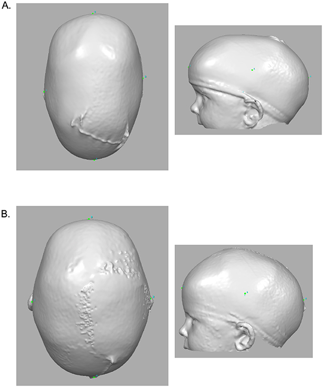 Figure 3 - 3D images of the head of a child diagnosed with sagittal craniosynostosis, taken (A) before and (B) after an endoscopic suturectomy [6].