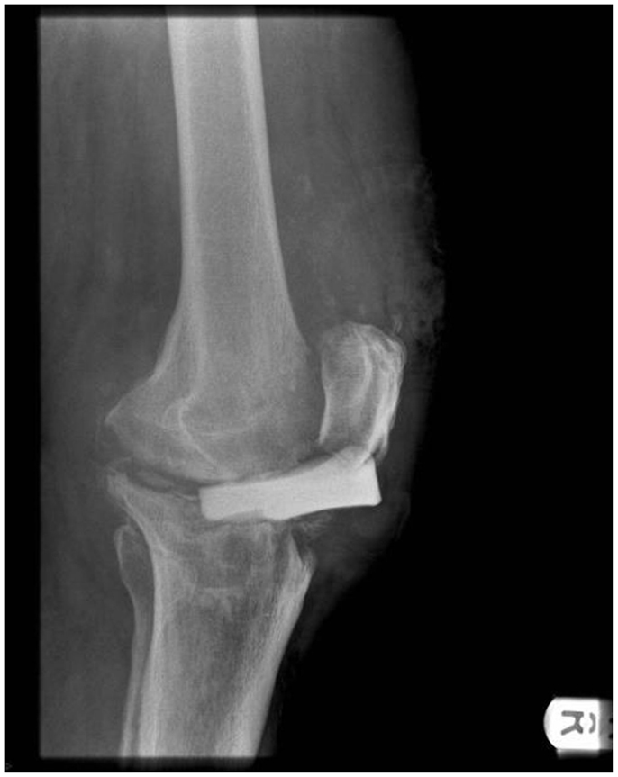 Frontiers | Patella Tendon Injuries Secondary to Cement Spacers Used at