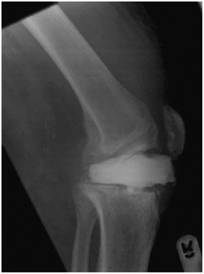 Frontiers | Patella Tendon Injuries Secondary to Cement Spacers Used at