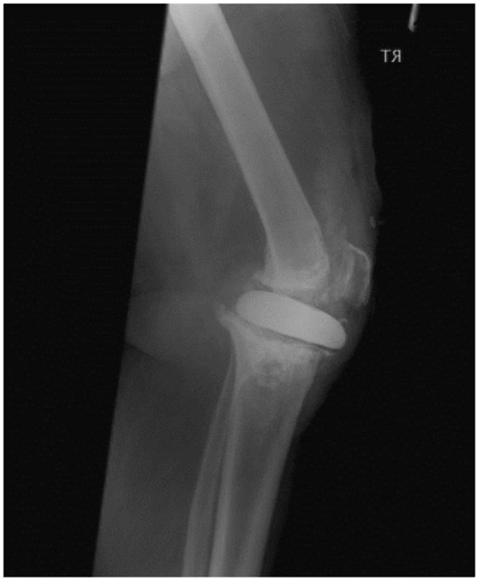 Frontiers | Patella Tendon Injuries Secondary to Cement Spacers Used at