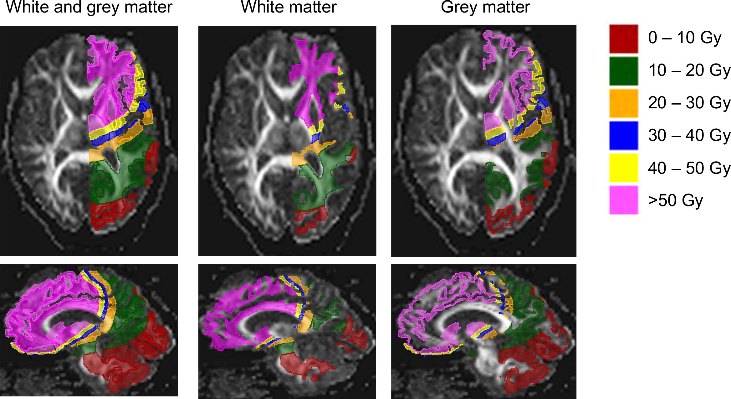 MRI scans show white and grey matter in the brain, with colored regions indicating various radiation dose levels ranging from zero to over fifty Gray. The top row illustrates axial white and grey matter sections, while the bottom row depicts sagitally acquired brain sections. Color legend: red (0-10 Gy), green (10-20 Gy), orange (20-30 Gy), blue (30-40 Gy), yellow (40-50 Gy), pink (over 50 Gy).