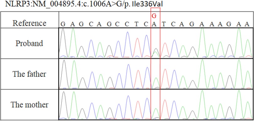 Genetic sequencing chromatograms for the NLRP3 gene showing three rows: Reference, Proband, and Parents. The proband's sequence has an A to G mutation highlighted at position c.1006, resulting in an Isoleucine to Valine substitution.