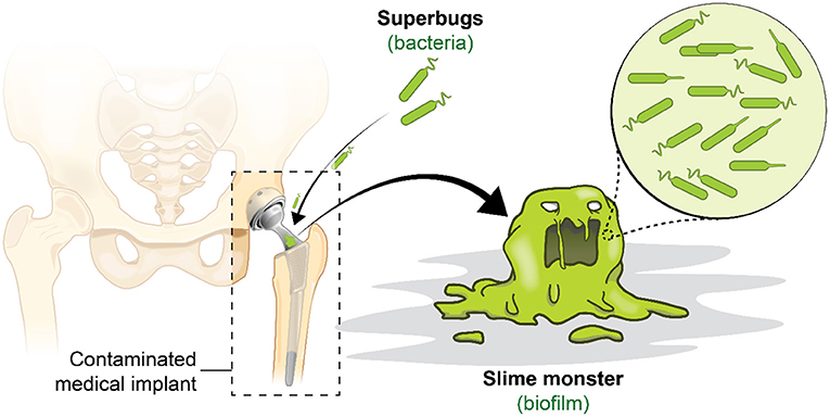Figure 1 - A hip replacement implant has been colonized by a slime monster! In this scenario, unwanted bacteria that contacted the metal implant before or during the surgery quickly attach to the implant and began to multiply.