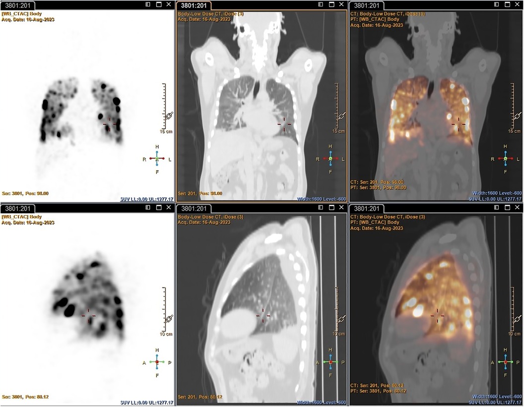 Frontiers | First-in-human infection imaging with 89Zr