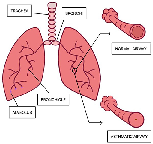 Figure 3 - Differences between a normal and asthmatic airway.