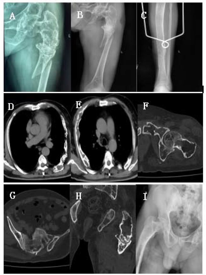 X-ray and CT scan images show various bones and anatomical views. Image (A,B) display hip joints, (C) shows leg bones with a brace, (D,E) are cross-sections of the chest, (F,G) focus on the pelvis, (H) reveals a detailed view of hip bones, and (I) presents a front view of the pelvic region.