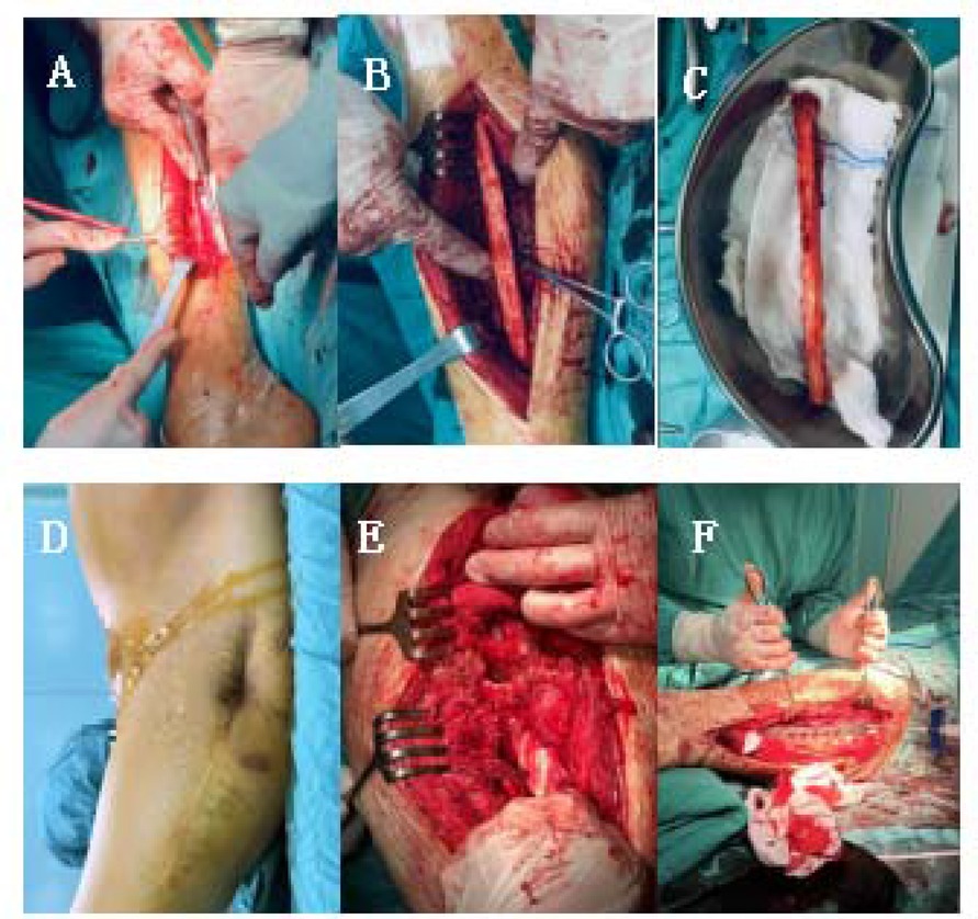 Surgical procedure series showing various stages. (A) Incision on the leg. (B) Exposure of a tissue structure. (C) Isolated vein in a metal tray. (D) Post-operative incision site on the arm. (E) Open surgical view with retractors. (F) Surgeons performing a procedure with tools.