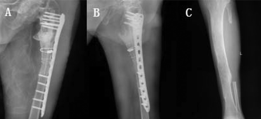 Three x-ray images labeled (A–C) show a femur with surgical hardware. Image (A) shows a side view with screws and a plate. Image (B) displays another angle with a rod and screws, while image (C) presents a standard lateral view without hardware.