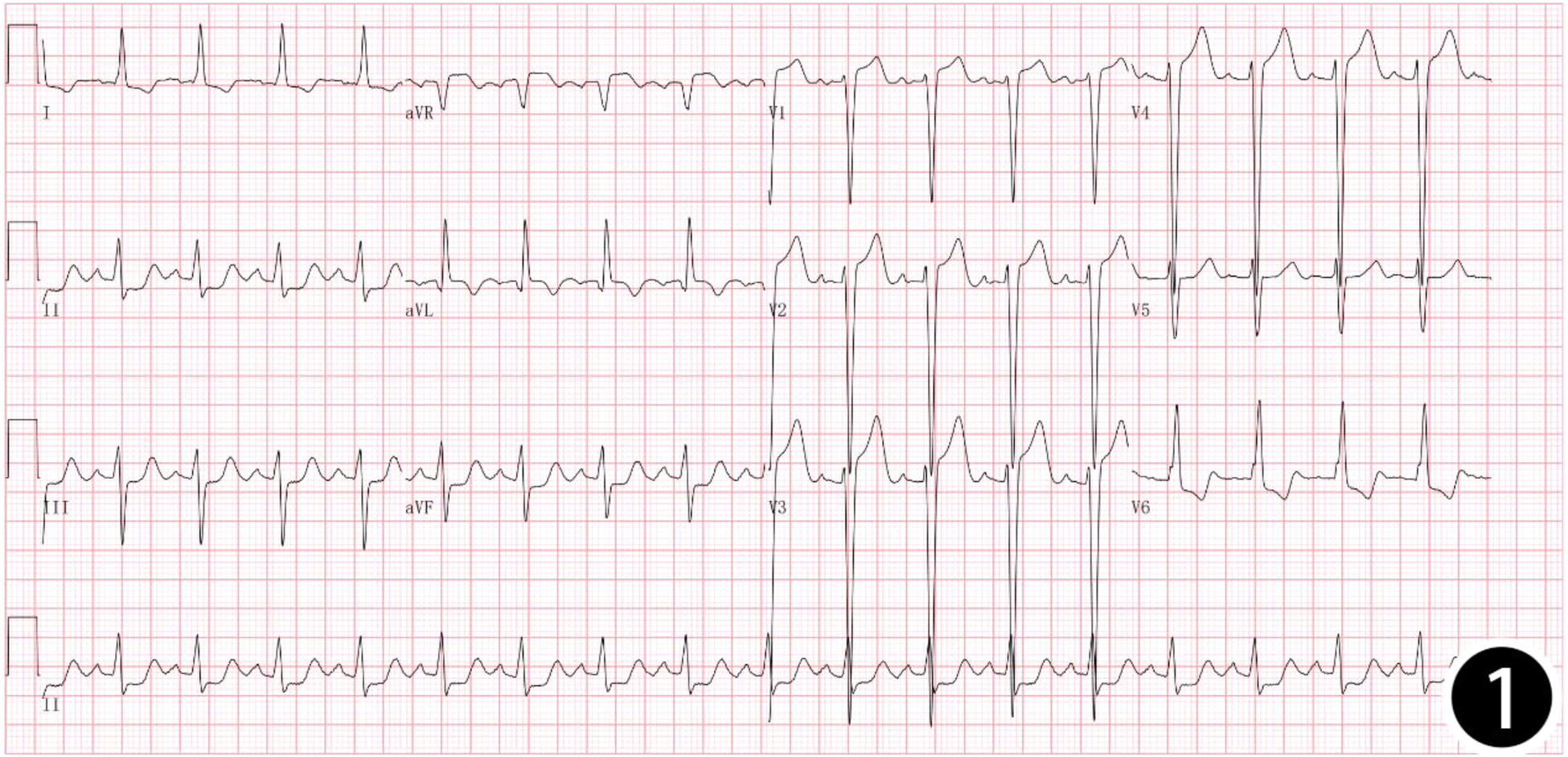 Electrocardiogram (ECG) showing heart rhythms across multiple leads. The tracing displays a regular pattern with prominent peaks and valleys representing the electrical activity of the heart.