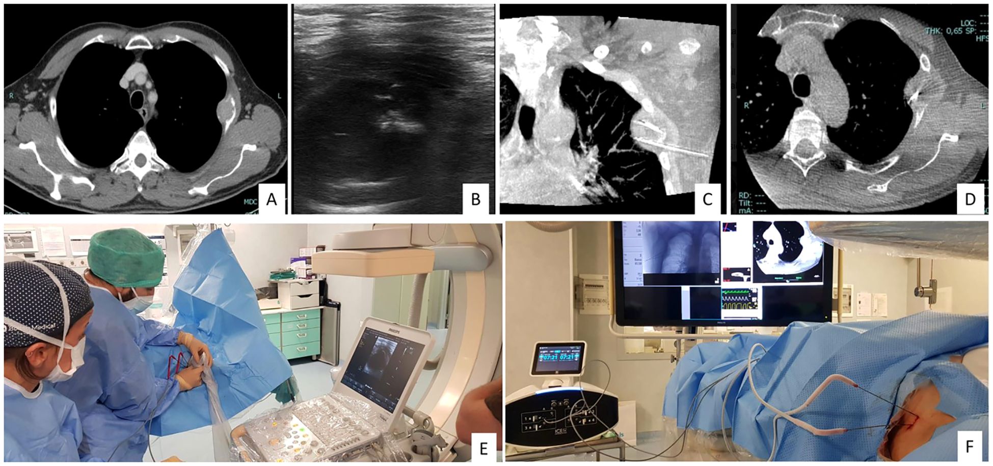 A series of six medical images labeled A to F. Image A: CT scan of the chest. Image B: Ultrasound of a thoracic area. Image C: CT showing a needle inserted in the chest. Image D: Another CT scan of the chest. Image E: Medical professionals performing a procedure using ultrasound guidance. Image F: A patient covered with blue drapes connected to medical equipment displaying various monitors.