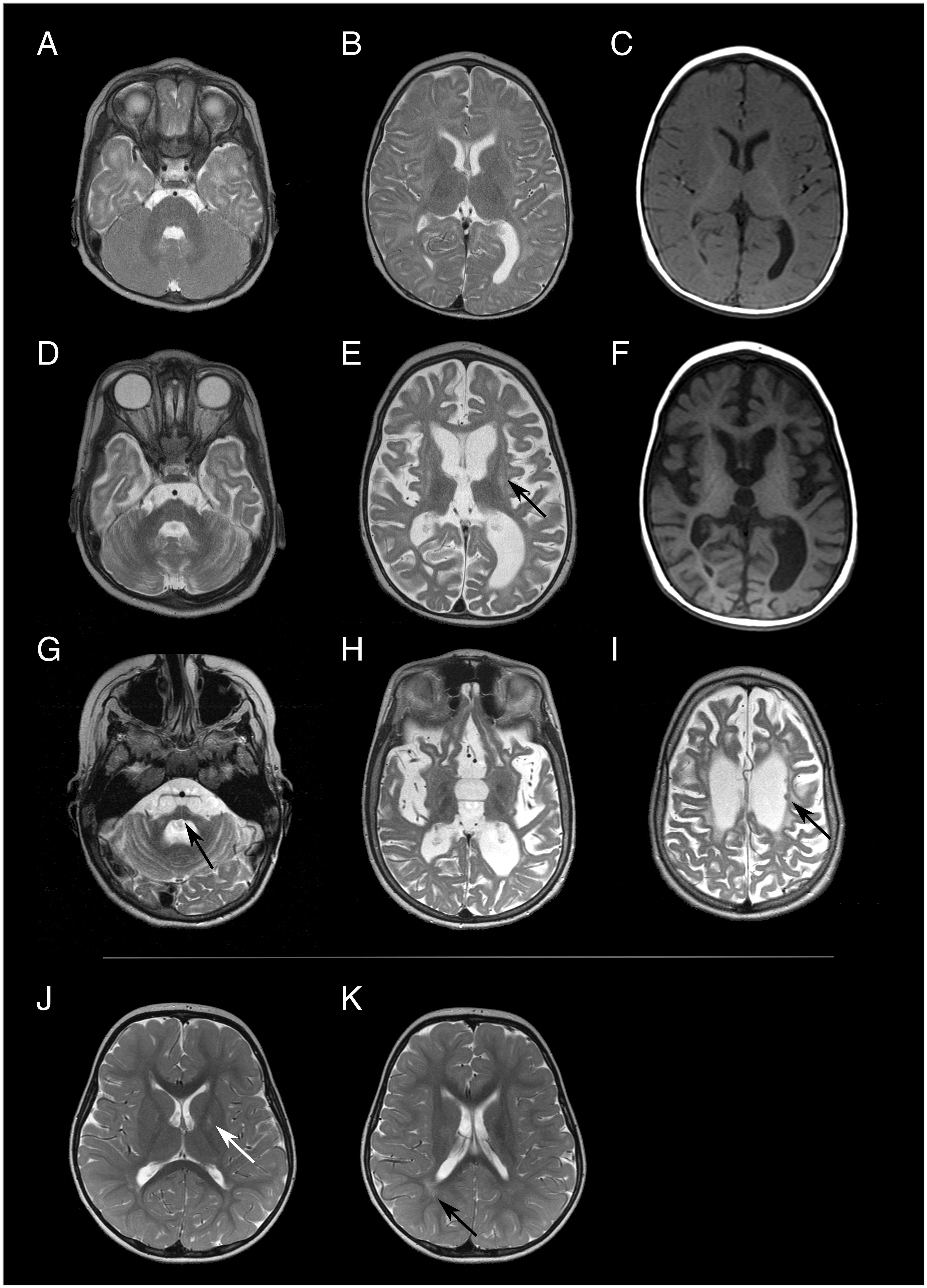 MRI scans showing various cross-sectional views of the human brain from multiple angles labeled A to K. Some images have arrows pointing to specific areas, indicating notable features or potential abnormalities for examination.