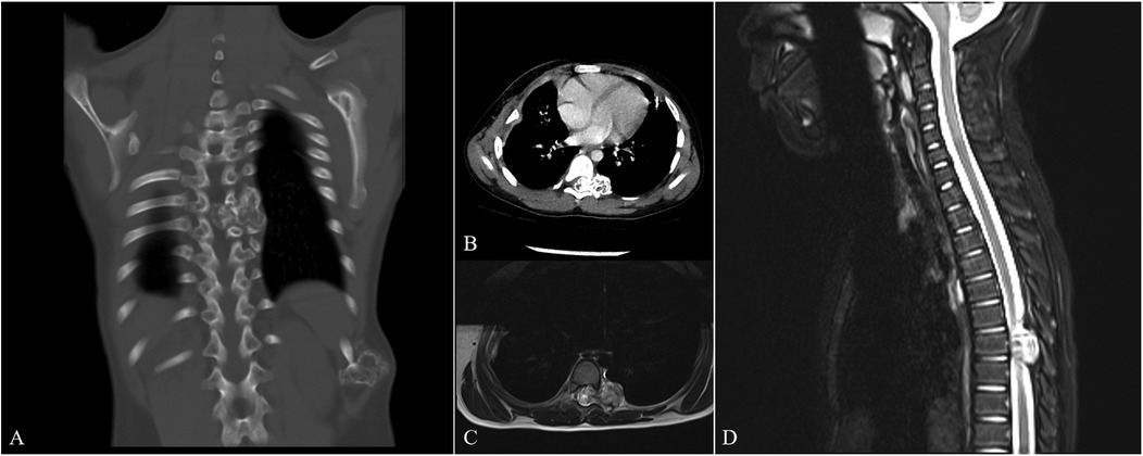 A four-panel radiological image showing different scans: (A) coronal CT scan of the thorax displaying spine and ribs; (B) axial CT scan of the chest highlighting the heart and lungs; (C) axial MRI of the thoracic region; (D) sagittal MRI of the spine, illustrating the spinal cord and vertebrae.