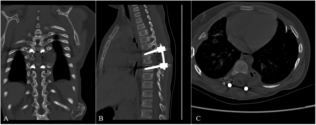 Three-panel x-ray images showing spinal structures. Panel A displays a coronal view of the thoracic spine with visible ribcage. Panel B shows a sagittal view with screws and a rod fixating the spine. Panel C presents a transverse section highlighting the thoracic cavity and soft tissues.