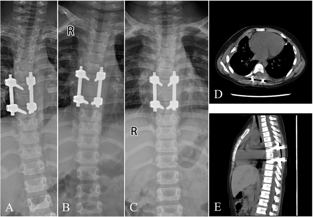X-ray and CT imagery showing different views of spinal fixation hardware. Images A, B, and C display frontal views of the thoracic spine with metal screws and rods. Image D shows a horizontal cross-section with visible internal structures. Image E provides a lateral view highlighting the spinal column's hardware placement.