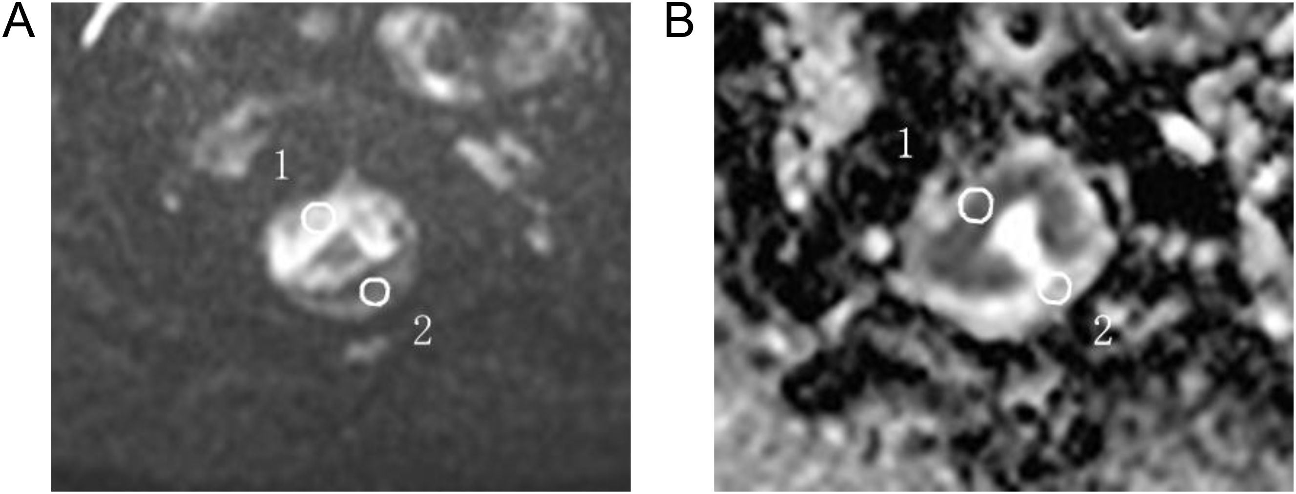 Two MRI scans labeled A and B, showing a medical image of tissue with two marked areas, numbered one and two. The image appears to be in grayscale, highlighting different textures and densities.