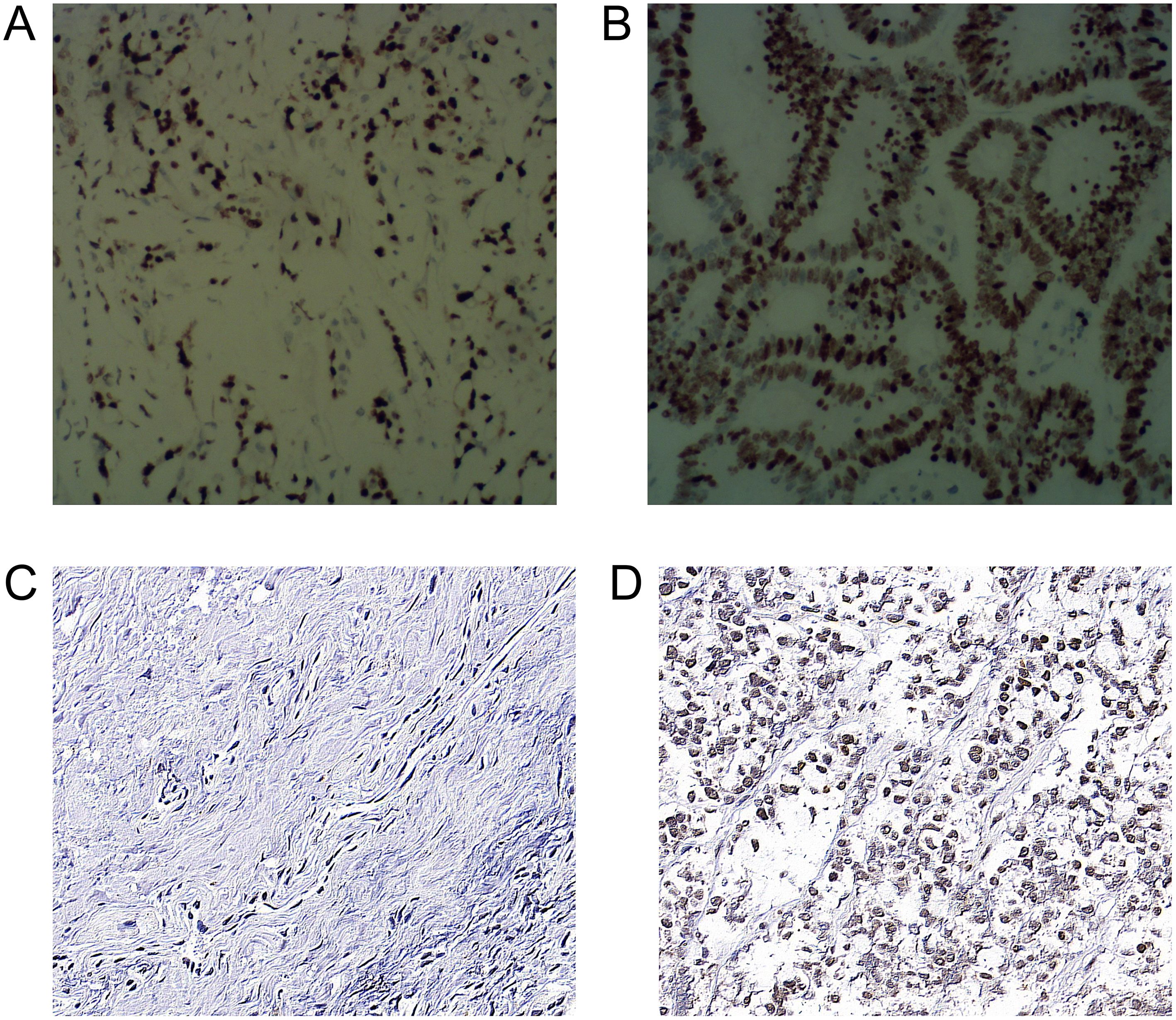 Microscopic images labeled A to D showing tissue samples. A and C display sparse cellularity with scattered dark-stained nuclei, while B shows dense, organized structures. D exhibits numerous dark-stained nuclei densely packed within the tissue.