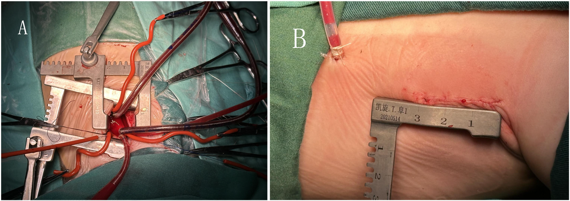 Panel A shows a close-up of a surgical procedure with retractors, tubing, and surgical tools in place. Panel B displays a post-surgical view of a sutured incision with a measuring device nearby.