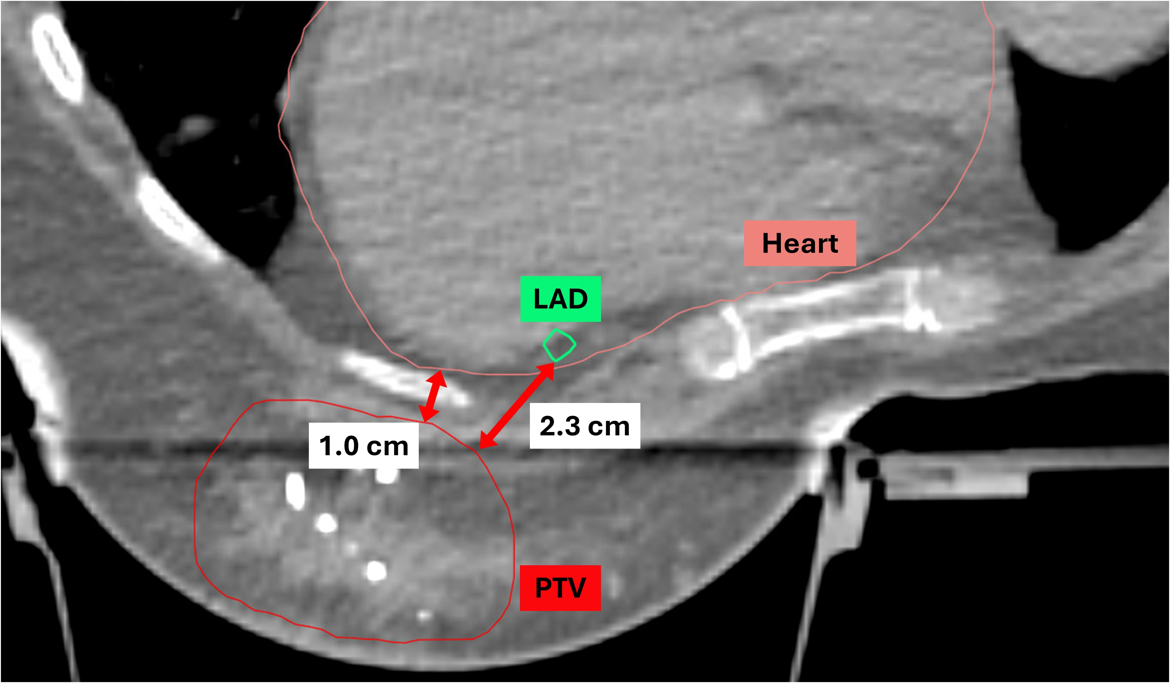 CT scan image showing a labeled cross-section with annotations highlighting the heart, LAD, and PTV. Distances between these structures are marked as 1.0 centimeters (D-H) and 2.3 centimeters (D-LAD), using red arrows and lines.
