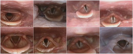 Close-up images of vocal cords showing various stages of opening and closing, capturing the deep red and brown hues of the tissue. The vocal folds are visible in different configurations and lighting.