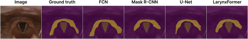 Comparison of laryngeal imaging and segmentation methods. The leftmost panel shows the original laryngeal image. The subsequent panels display segmentations of the laryngeal region: Ground truth, FCN, Mask R-CNN, U-Net, and LarynxFormer. Segmented areas are highlighted in yellow on a purple background.