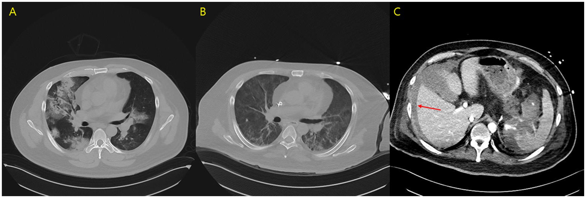 CT scan images with three panels labeled A, B, and C. Panel A and B show axial views of the lungs with areas of opacification, indicating possible lung disease. Panel C shows an abdominal view with a red arrow pointing to a specific area, suggesting a point of interest for diagnosis.
