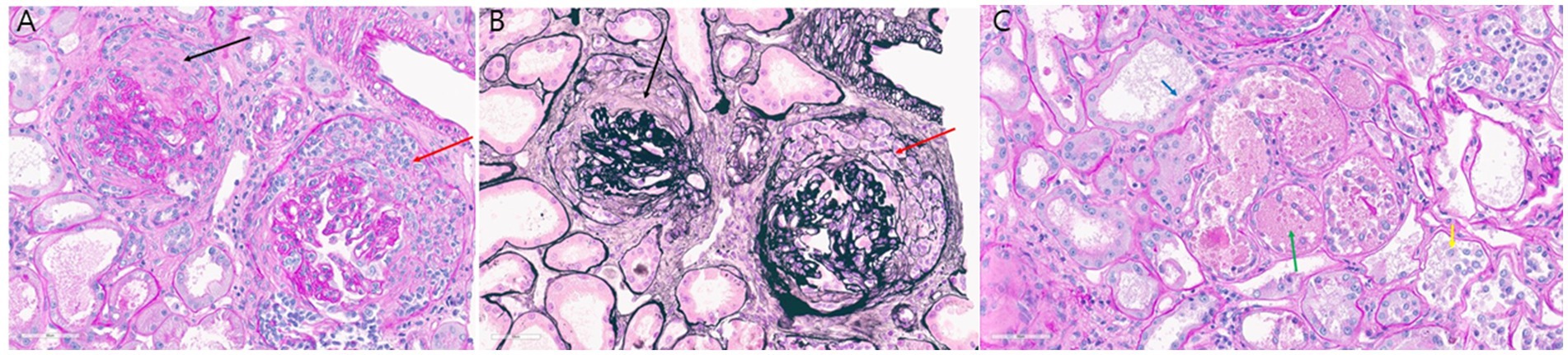 Histological images of kidney tissue: Panel A shows a glomerulus with noticeable mesangial expansion. Panel B highlights sclerosis within a glomerulus. Panel C displays reduced cellularity with some fibrotic changes in the interstitium. Various colors highlight different structures.