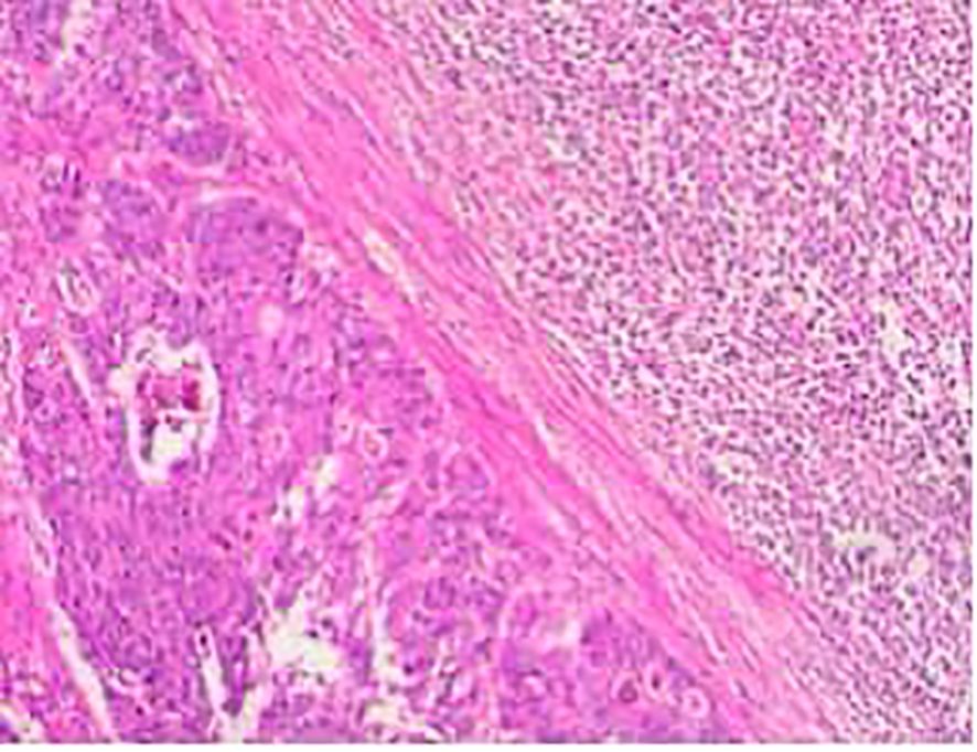 Microscopic image showing tissue sections stained in pink hues, highlighting cellular structures. The left side displays a denser cellular arrangement, while the right side appears more loosely organized.