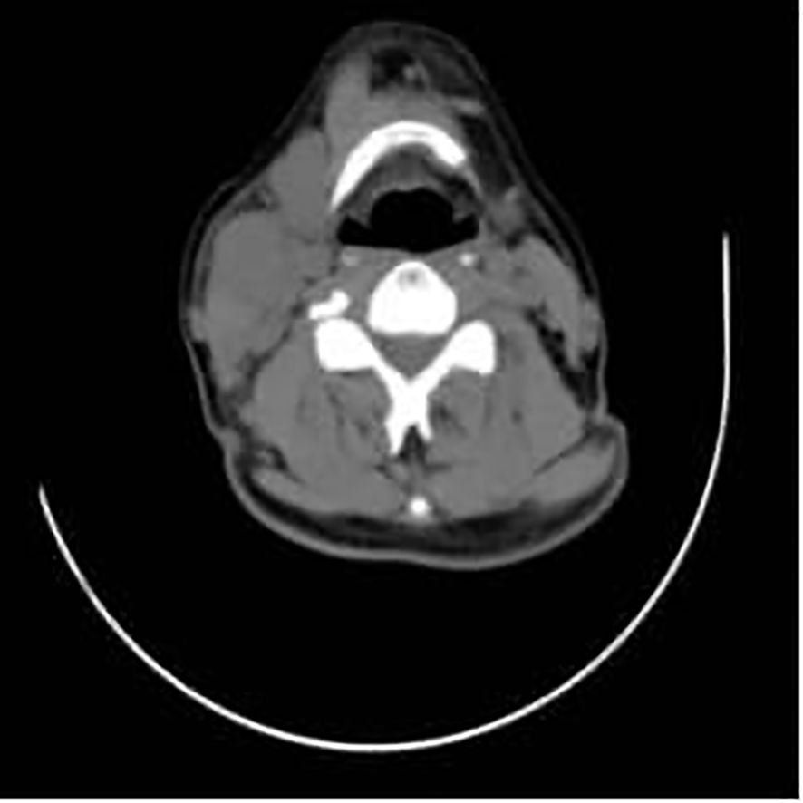 CT scan of a cross-sectional view of the neck, showing various soft tissues and bone structures. The spinal cord and vertebrae are visible, surrounded by other anatomical features.