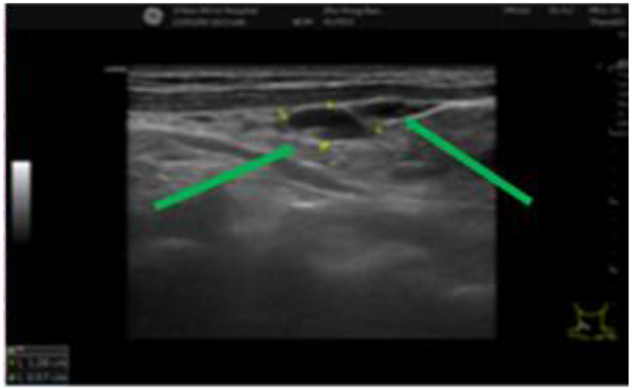 Ultrasound image showing a cross-sectional view of tissue with two green arrows pointing towards a dark circular area in the center, likely indicating an area of interest or abnormality.