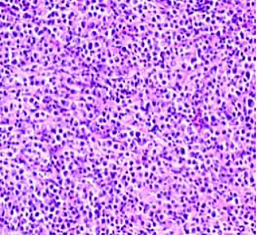 Microscopic image displaying a dense, uniform collection of dark purple and light pink stained cells, characteristic of a histological tissue sample.