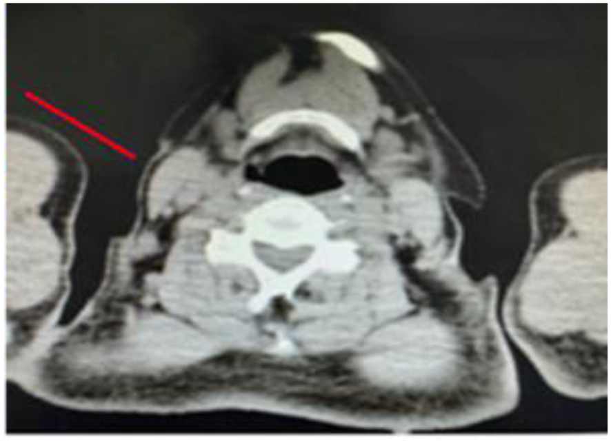 CT scan image of a neck cross-section showing internal structures. A red arrow points to a specific area on the left, potentially indicating a notable feature or abnormality.